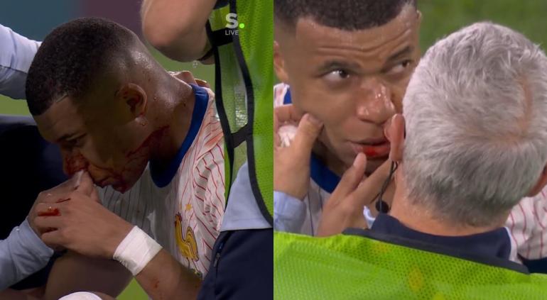 Le rompieron nariz a Mbappé durante partido vs Austria